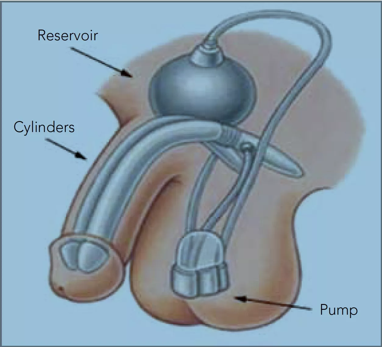 Implant pénien